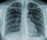 lung image